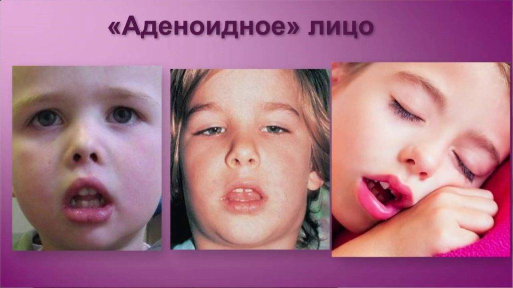 Гнойный аденоидит у детей: симптомы, лечение pulmono.ru
гнойный аденоидит у детей: симптомы, лечение