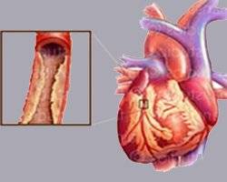 Атеросклеротический кардиосклероз: причины, лечение, прогноз