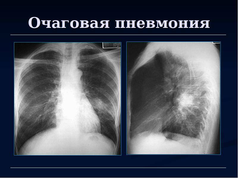 Очаговая пневмония: симптомы и лечение при правосторонней и левосторонней форме