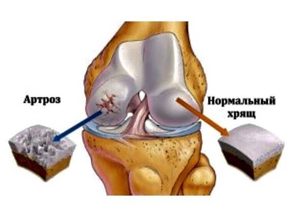 Хондромаляция коленного сустава 3 степени: лечение в клинике стопартроз в москве