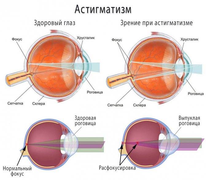 Астигматизм - что это у детей: сложный, гиперметропический, прямой глаз