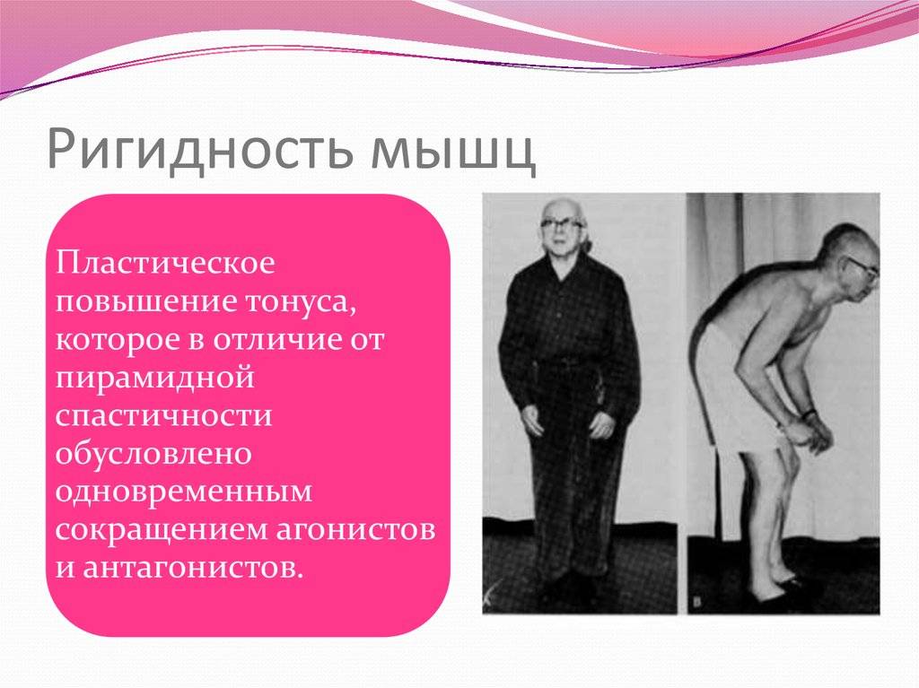 Ригидность затылочных мышц. что это, как определить у детей, взрослых, причины, лечение — medists.ru