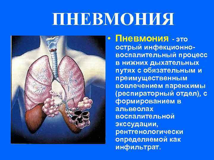 Заразна ли пневмония у взрослых - передается ли астма воздушно-капельным путем