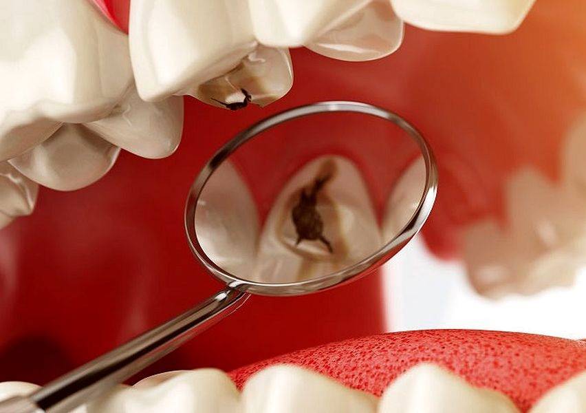 Как лечить кариес зубов: современные методы, этапы, куда обратиться