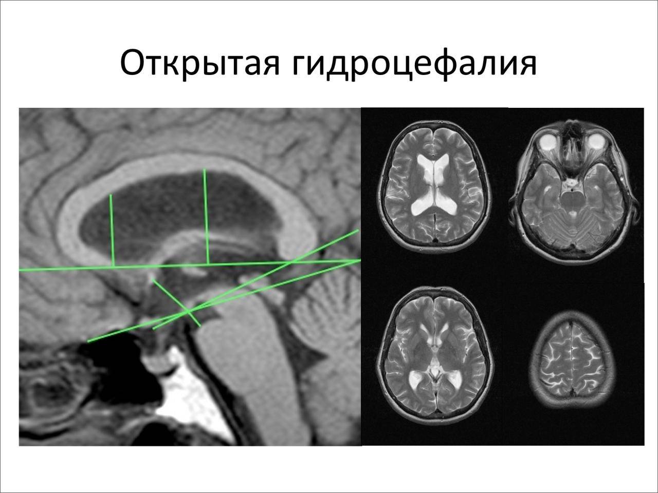 Гидроцефалия, органическое поражение мозга, понятие гидроцефалии формы гидроцефалии этиология