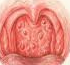 Гранулезный фарингит хронический - как лечить: лечение лимфоидных гранул в горле, как вылечить острый гранулярный, симптомы зернистого у взрослых