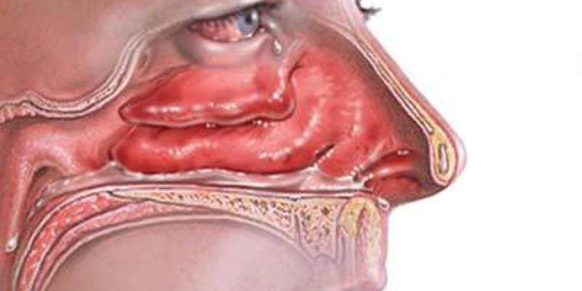 Воспаление в носу: основные причины. лечение. как снять боль?