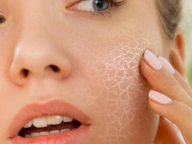 Сухая кожа тела: 5 главных причины и что делать