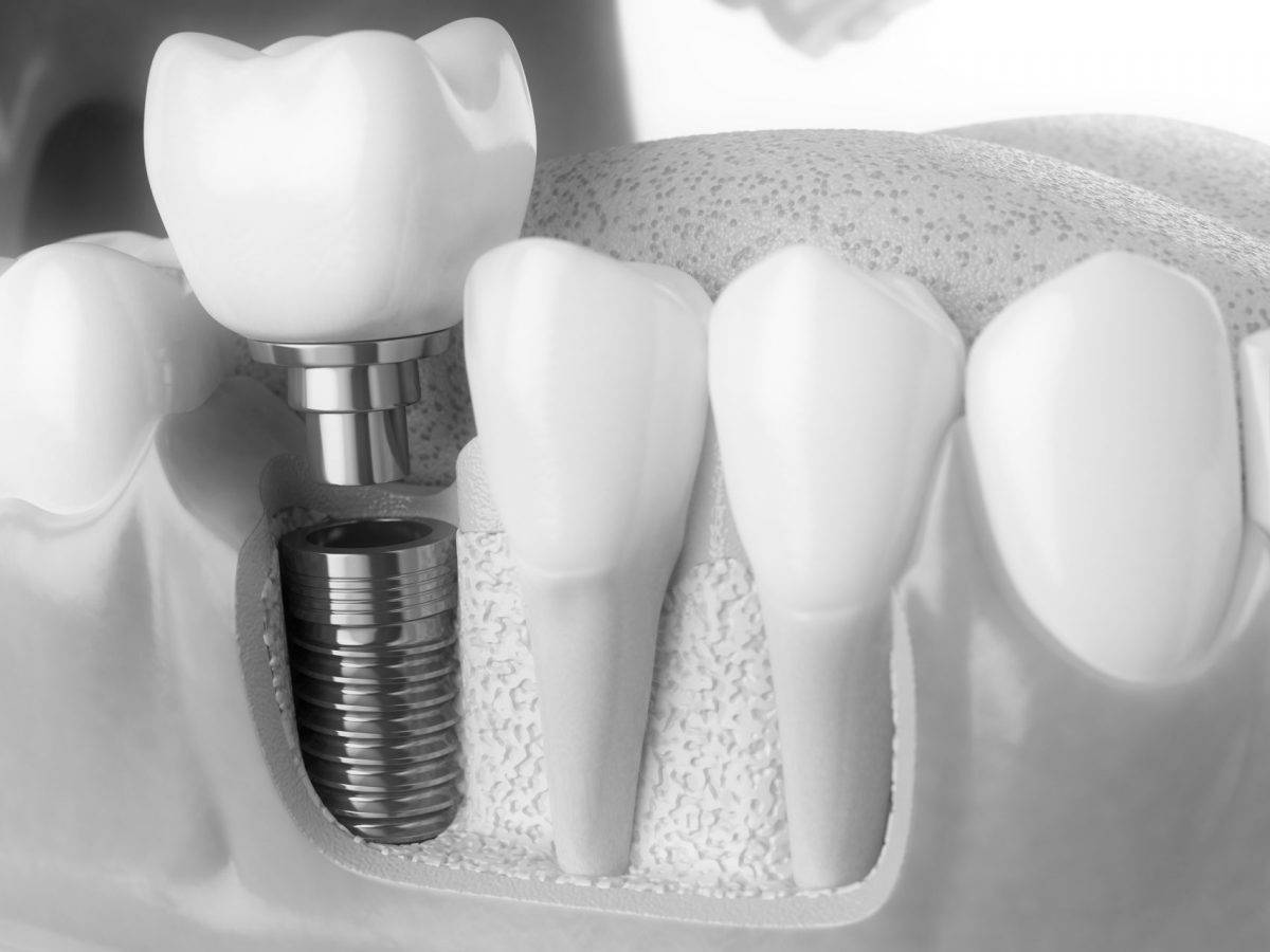 Что такое синус лифтинг в стоматологии: виды имплантации зубов при этой операции и послеоперационный период