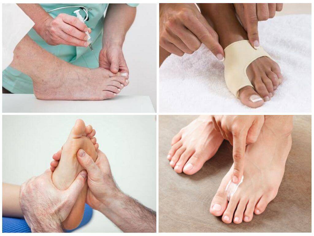 Массаж ног после операции. Массаж от косточки на ноге. Массаж при вальгусной деформации большого пальца. Массаж косточки на большом пальце ноги. Косточка на ноге упражнения.