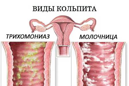 Правильное лечение вагинита кольпита во время беременности