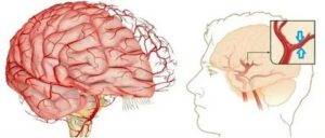 Спазм сосудов головного мозга: симптомы, лечение, препараты и таблетки