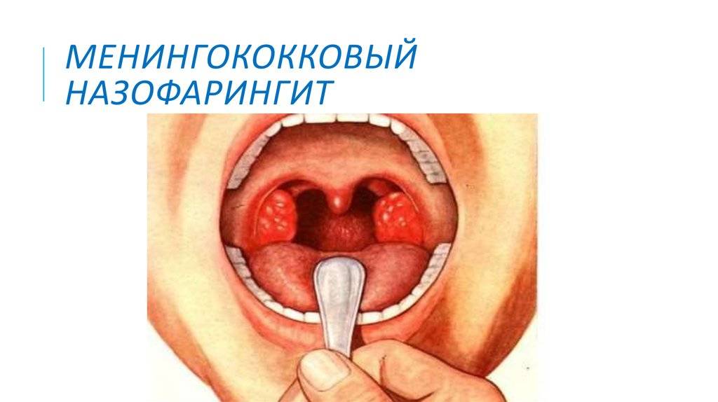 Гранулезный фарингит хронический - как лечить: лечение лимфоидных гранул в горле, как вылечить острый гранулярный, симптомы зернистого у взрослых