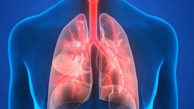 Пневмония - симптомы у взрослых и как распознать первые проявления заболевания