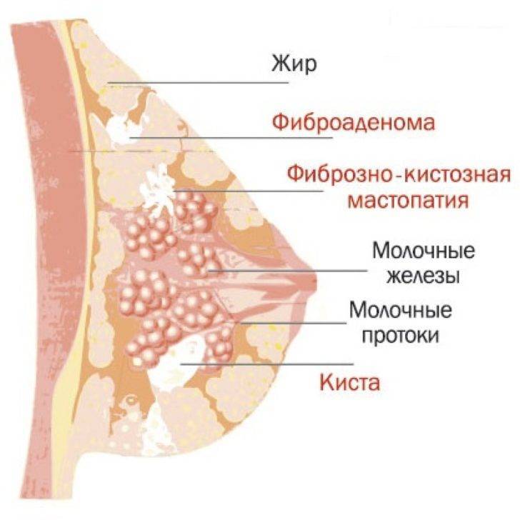 Фиброзно-кистозная мастопатия - симптомы и лечение народными средствами и препаратами, фото