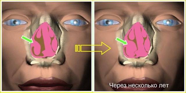 Что такое гиперпластический ринит: признаки и симптомы заболевания слизистой носа