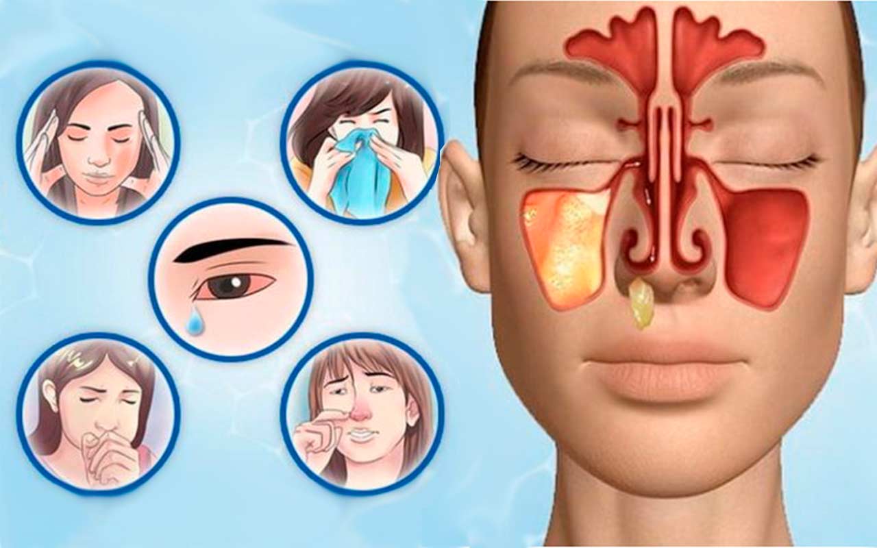 Воспаление носовых пазух: симптомы и лечение, как и чем лечить
