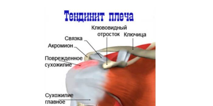 Воспаление сухожилий плечевого сустава или тендинит надостной мышцы: лечение, симптомы, формы и стадии заболевания