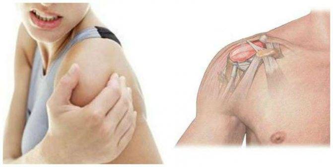 Плексит плечевого сустава: симптомы, лечение - medside.ru