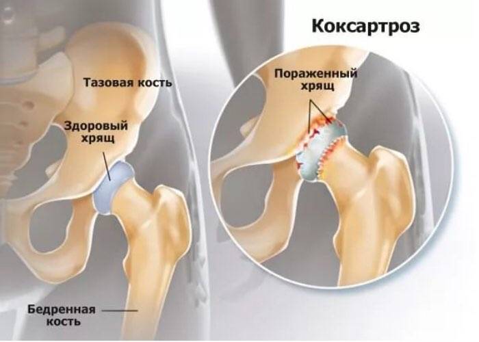 Лечение артрита тазобедренного сустава народными средствами
