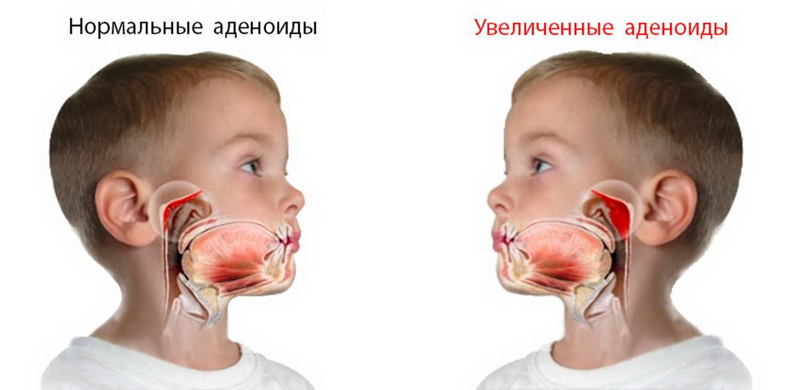 Аденоидит у ребенка - симптомы и лечение если жидкость в ушах при аденоидах