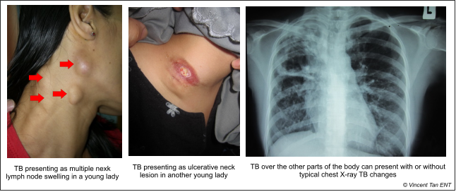Признаки туберкулеза на ранних стадиях и лечение легких у взрослых