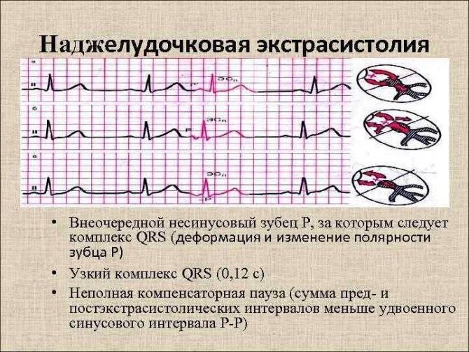 Суправентрикулярная экстрасистолия: что это такое, код по мкб-10, признаки у взрослых и детей, причины развития, лечение и последствия нарушения ритма сердца