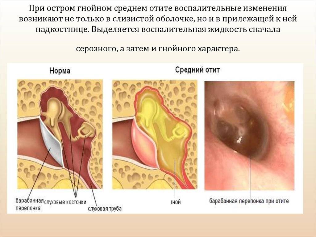 Воспаление среднего уха: развитие, симптомы, диагностика, лечение