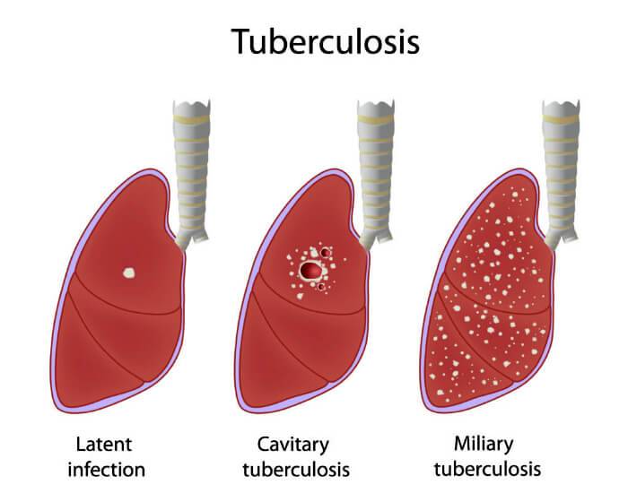 Симптомы туберкулёза у женщин