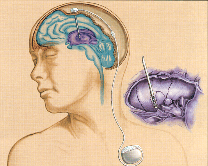 Мозг через рот. Вживляемые в мозг электроды. Вживление электродов в мозг. Нейростимуляция головного мозга. Нейрохирургия головного мозга.