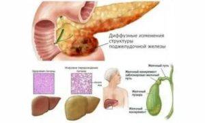 Диффузные изменения поджелудочной железы по типу липоматоза прогноз