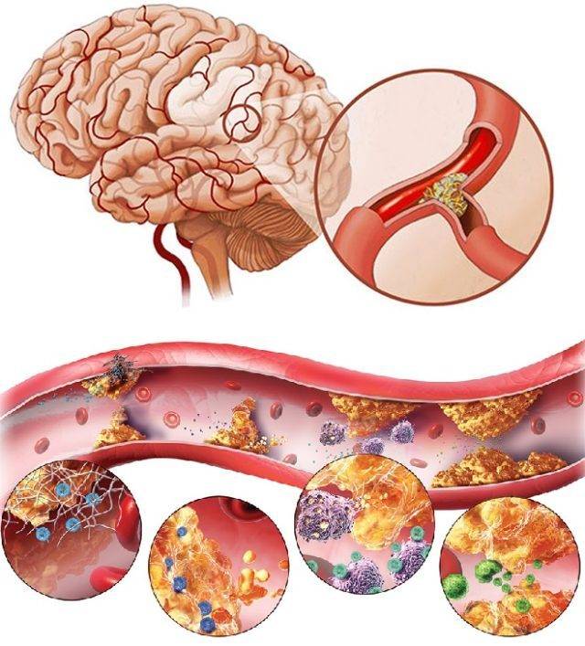 Атеросклероз сосудов головного мозга (церебральный атеросклероз) – симптомы, лечение, профилактика
