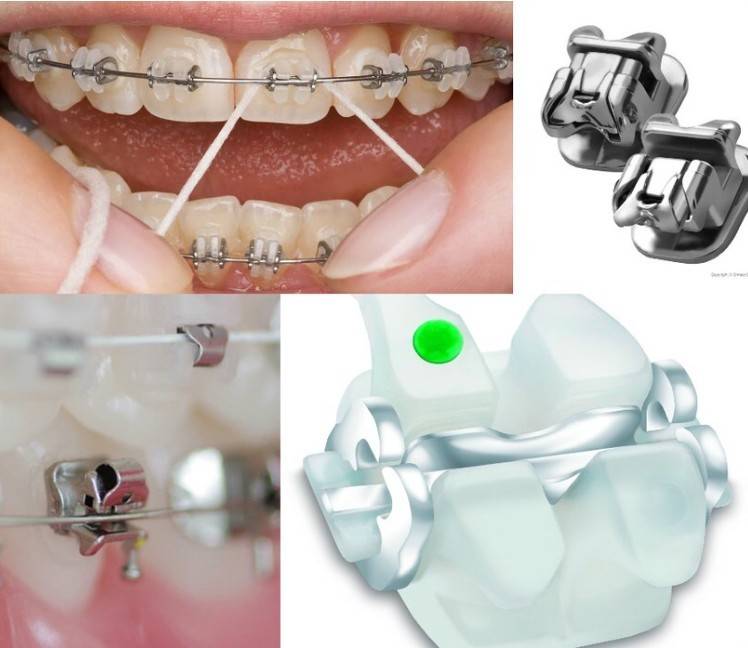Как ставят брекеты на зубы: подготовка и процесс установки