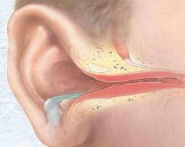 Чем лечить отит уха у взрослых в домашних условиях?