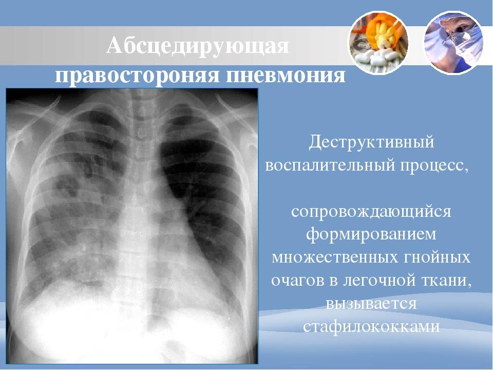Абсцесс легкого (абсцедирующая пневмония): симптомы, причины и лечение