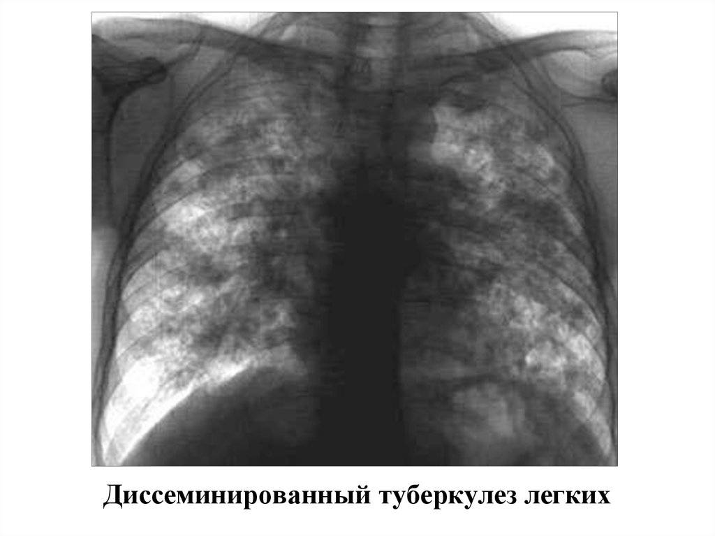 Туберкулез легких код по мкб 10