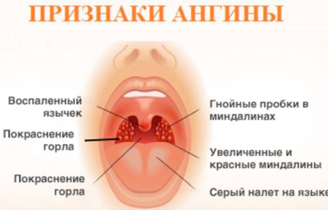 Бактериальный тонзиллит - лечение ангины: как лечить бактерии в горле и инфекцию, симптомы острого