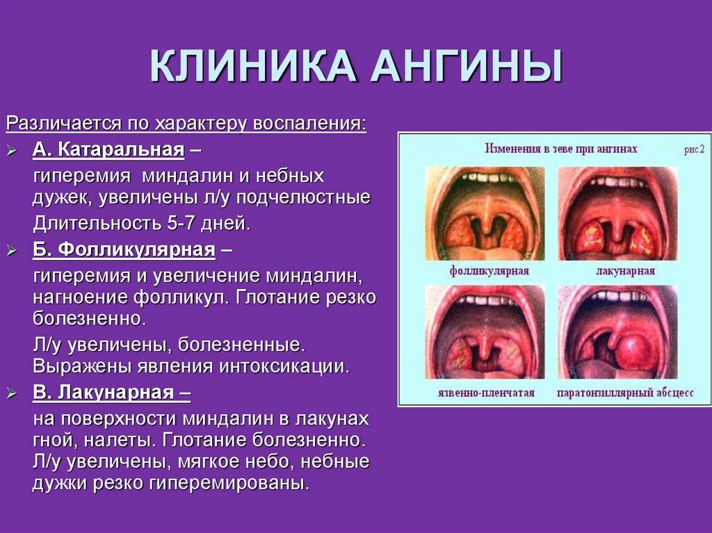 Ангина (острый тонзиллит) - обзор информации | компетентно о здоровье на ilive