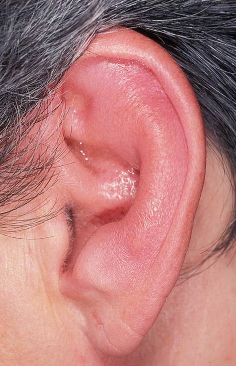 Отит наружного уха – симптомы и лечение воспаления