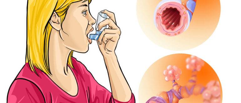 Причины и механизм развития приступа астмы, симптомы, первая помощь, лечение