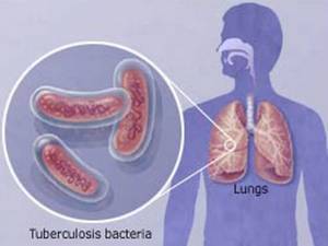Как передается туберкулез: от человека, каким путем, заражаются, воздушно-капельным, половым