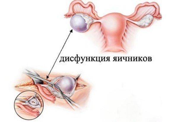 Гипофункция яичников у женщин: лечение и признаки