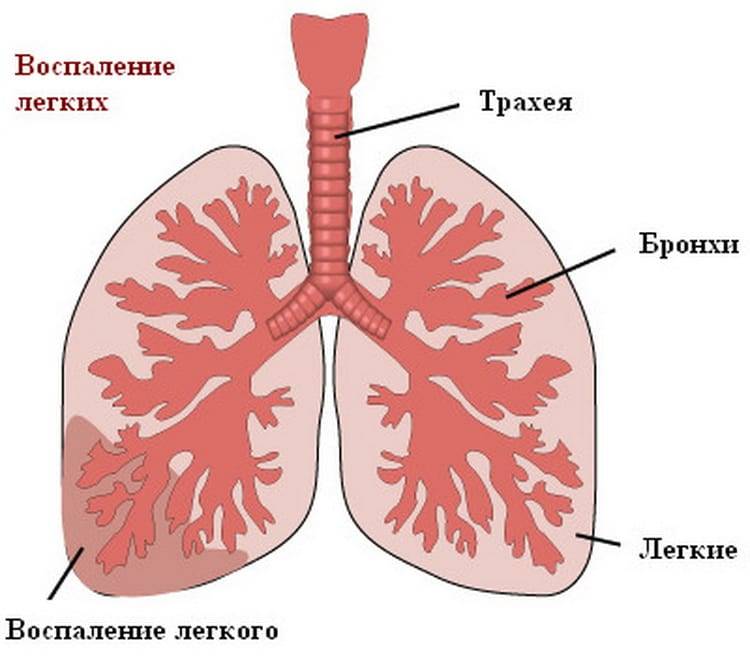 Бронхит и пневмония — отличия и сходство