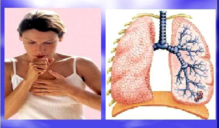 Как облегчить кашель при воспалении легких у взрослых