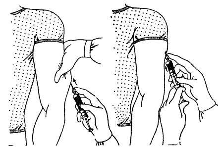 Как делать укол в плечо: место укола, техника выполнения