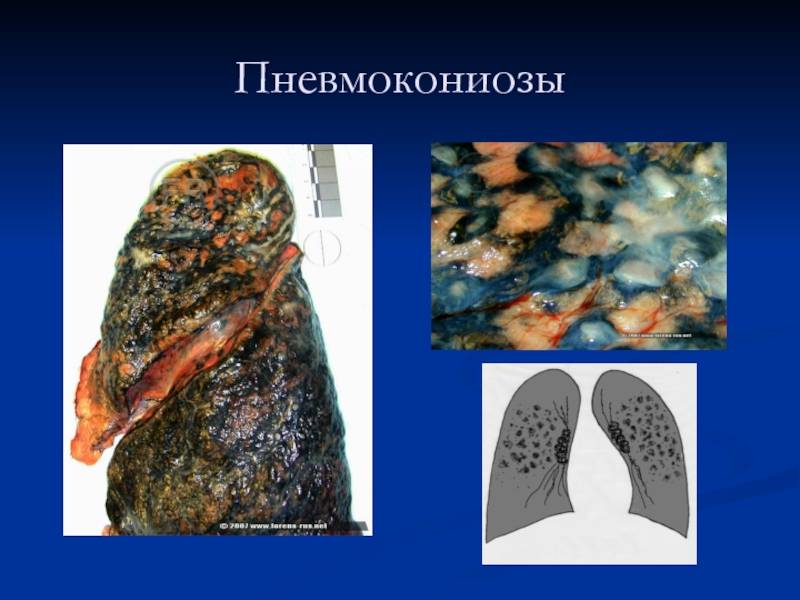 Дифференциальная диагностика туберкулеза и других заболеваний легких