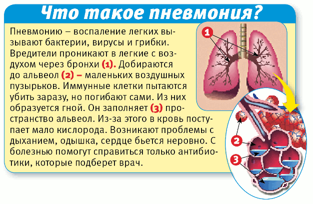 Инфекция легких: виды, причины, признаки и лечение болезни — net-bolezniam.ru
