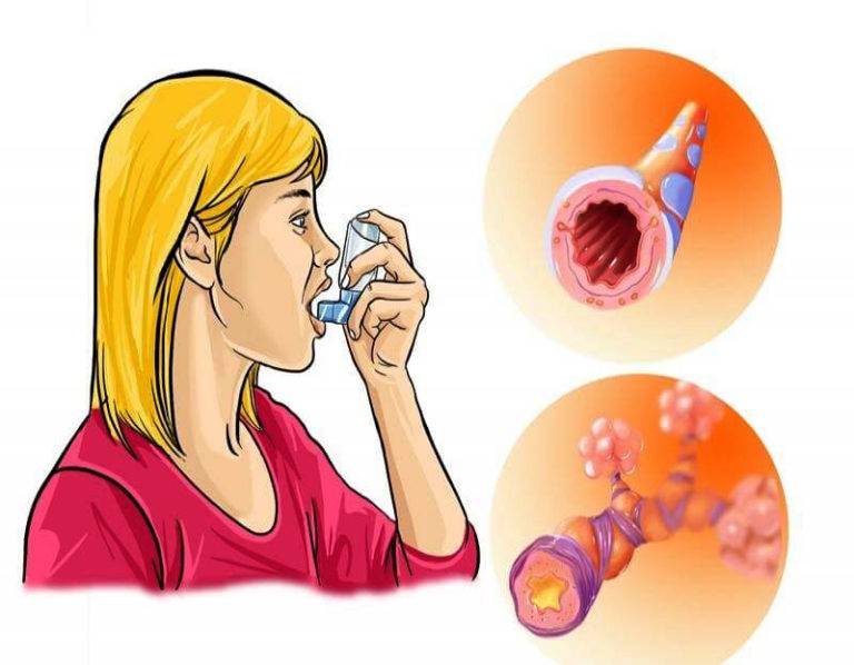 Как вылечить астму у ребенка - эффективные методы.