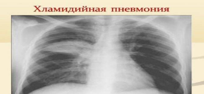 Передается ли пневмония воздушно капельным путем