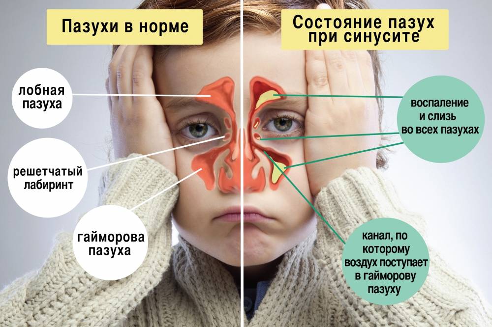 Вирусный и бактериальный гайморит — симптомы и лечение — гаймориты.ру